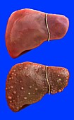Health liver and cirrhotic liver, illustration