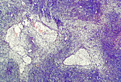 Central nervous system tumour, light micrograph