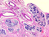 Breast fat necrosis, light micrograph