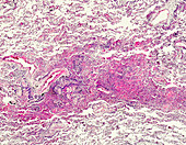 Pulmonary fibrosis of the lung, light micrograph
