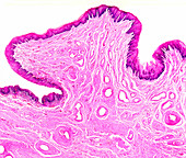 Severe cervical dysplasia, light micrograph