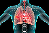 Pulmonary mucormycosis, illustration