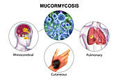 Clinical forms of mucormycosis, illustration