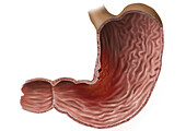 Advanced stomach cancer, illustration