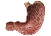 Early stomach cancer, illustration