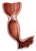 Oesophageal narrowing, illustration