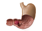 Gastric polyp, illustration