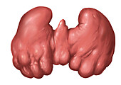 Thyroiditis, illustration