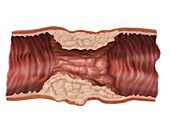 Infiltrating adenocarcinoma of the colon, illustration