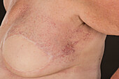 Patient with burns following radiotherapy and spider veins
