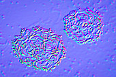 Bacterial vaginosis, illustration