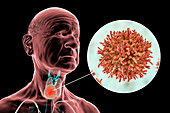 Thyroid gland cancer, illustration