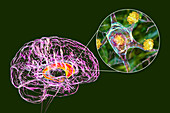 Neuronal inclusions in Huntington's disease, illustration