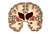 Brain in Huntington's disease, illustration