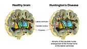 Normal brain and brain in Huntington's disease, illustration