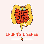 Crohn's disease, conceptual illustration
