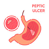 Peptic ulcer diagnosis, conceptual illustration