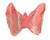 Diseased thyroid, illustration