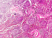Pulmonary tuberculosis, light micrograph