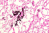 Pulmonary interstitial emphysema, light micrograph