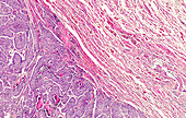 Neuroendocrine tumour of the lung, light micrograph