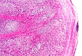 Kaposi's sarcoma, light micrograph