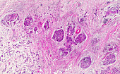 Pancreatic neuroendocrine tumour, light micrograph