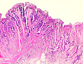 Gastrointestinal stromal tumour, light micrograph