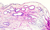 Juvenile polyposis syndrome, light micrograph