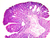 Familial adenomatous polyposis, light micrograph