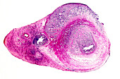 Appendix cancer, light micrograph