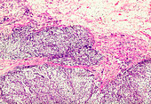 Extragonadal germ cell tumour, light micrograph
