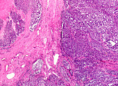 Anal cancer, light micrograph