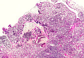 Classical swine fever lymph node section, light micrograph