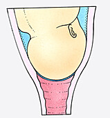 Baby's head resting on a fully dilated cervix, illustration