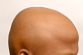 Alopecia totalis