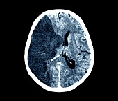 Stroke, CT scan