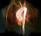 Aortic aneurysm, MRA