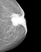 Breast lesion, X-ray
