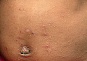 Scabies infection on the skin
