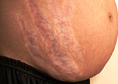 Stretch marks in Cushing syndrome