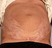 Stretch marks in Cushing syndrome