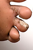 Common warts after treatment