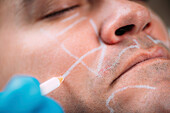Facial contouring before filler treatment