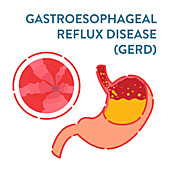 Gastroesophageal reflux disease, illustration