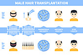 Hair transplantation in men, illustration