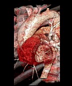 Aortic aneurysm, 3D CT angiogram