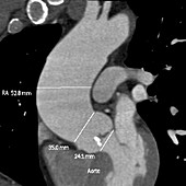 Aortic aneurysm, 2D CT angiogram