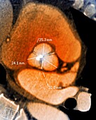 Aortic aneurysm, CT angiogram