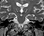 Parkinson's disease electrode implants, MRI scan